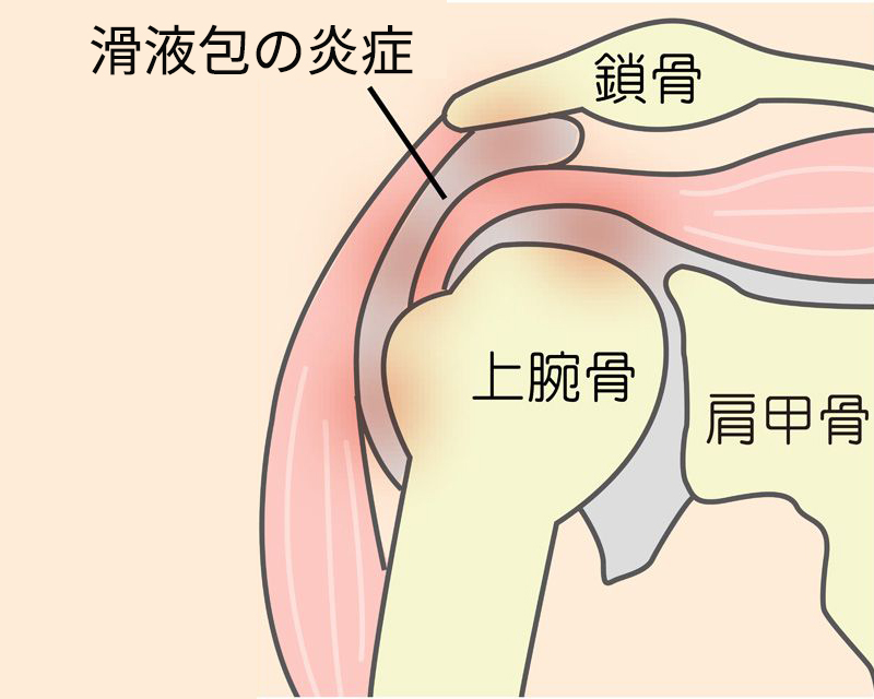 上腕骨に付着する腱の炎症