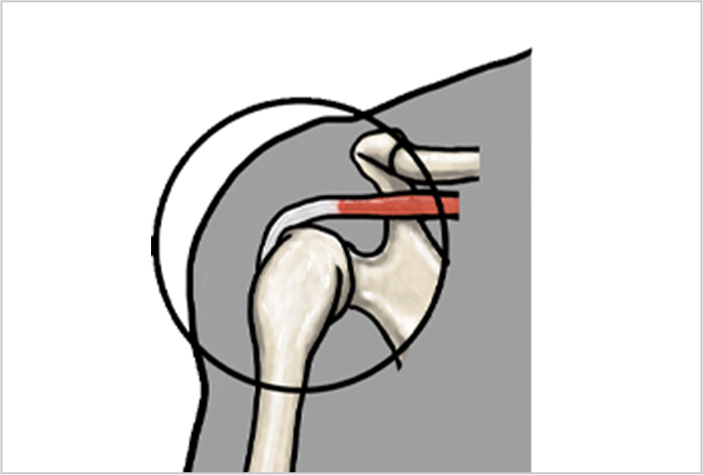 腱や筋肉が切れている