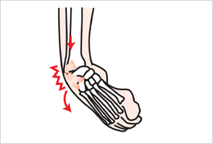 足を捻ったケガ