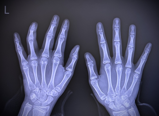 手のレントゲン写真